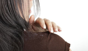 Dandruff and hair loss