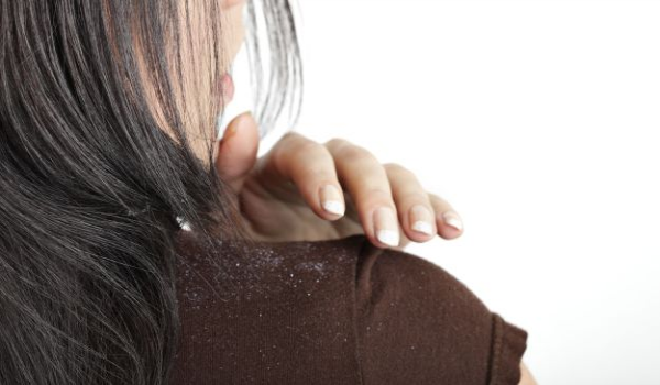How to prevent Dandruff and hair loss