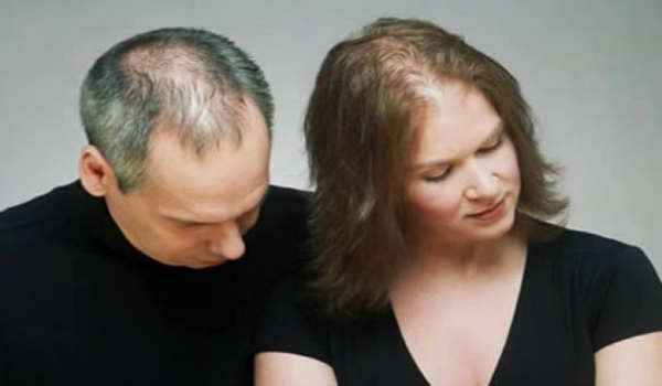 Causes of Baldness