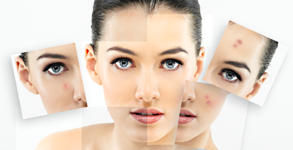 How to get rid of acne scars naturally