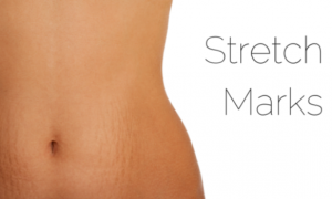 Stretch Marks