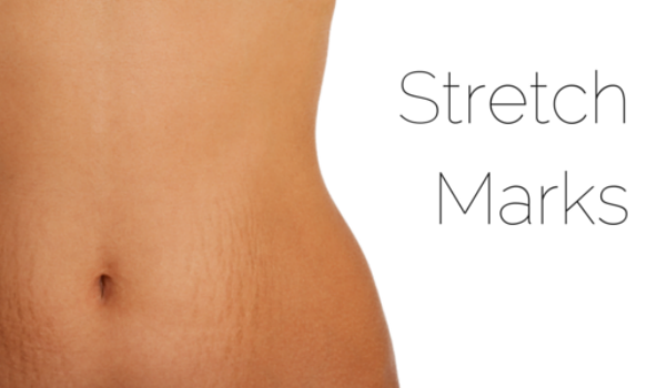 Stretch Marks : Causes and Treatments