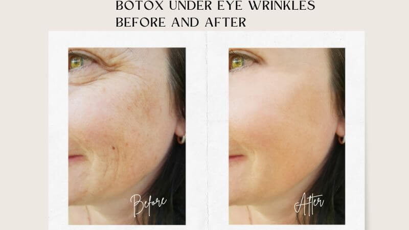 Botox under eye wrinkles before and after